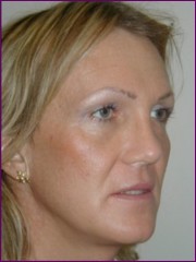 After facial feminisation